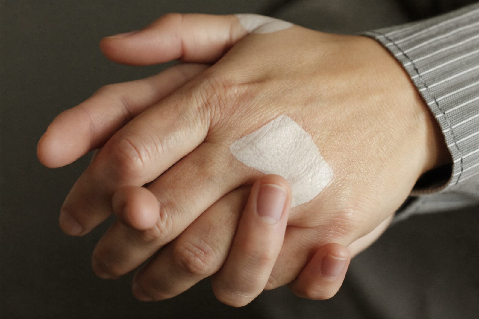 Vitiligo: An Autoimmune Condition, Not a Cosmetic One